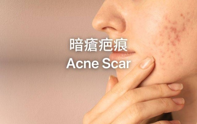 Acne Scar Removal